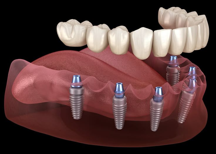 Implant Dentistry
